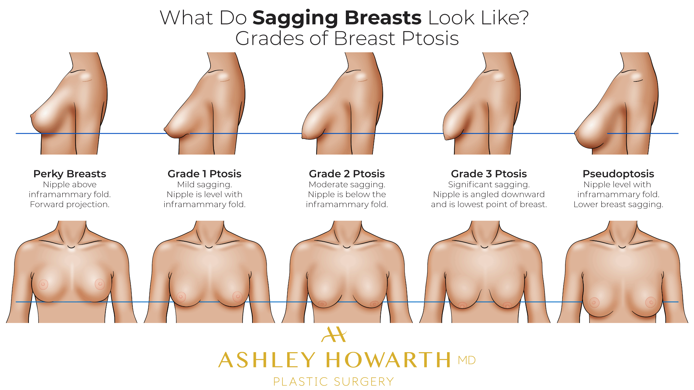 dodi rox recommends big saggy floppy tits courtney rego add Big breast indian nude photo